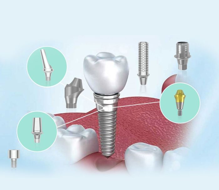 Prosthetic Abutments